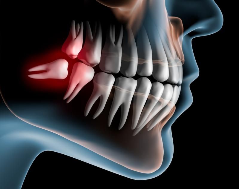 Extractions & Wisdom Teeth